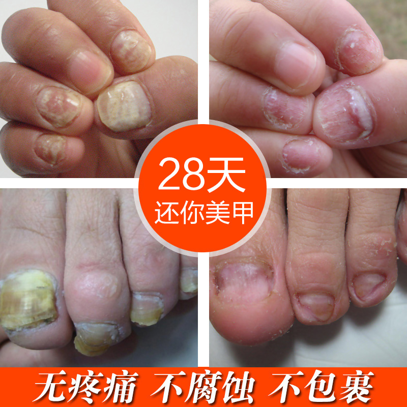 希妃施灰指甲膏批发 灰指甲液 灰指甲水套装灰甲亮 OEM贴牌